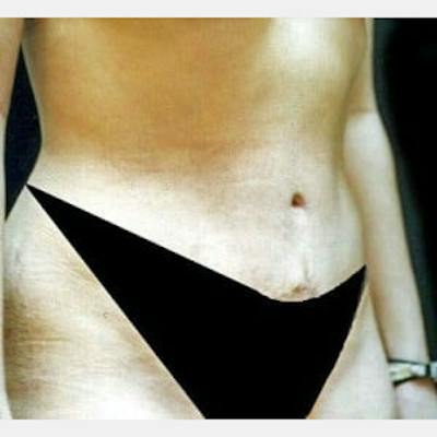 Abdominoplasty (Tummy Tuck) Before & After Gallery - Patient 419985 - Image 2