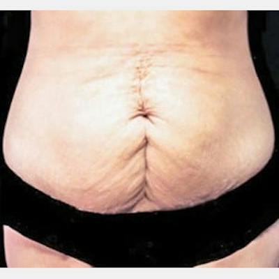 Abdominoplasty (Tummy Tuck) Before & After Gallery - Patient 224503 - Image 1