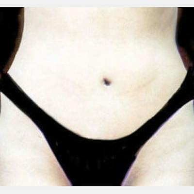 Abdominoplasty (Tummy Tuck) Before & After Gallery - Patient 224503 - Image 2