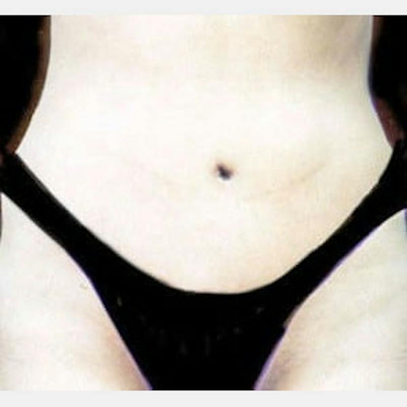 Abdominoplasty (Tummy Tuck) Before & After Gallery - Patient 224503 - Image 2