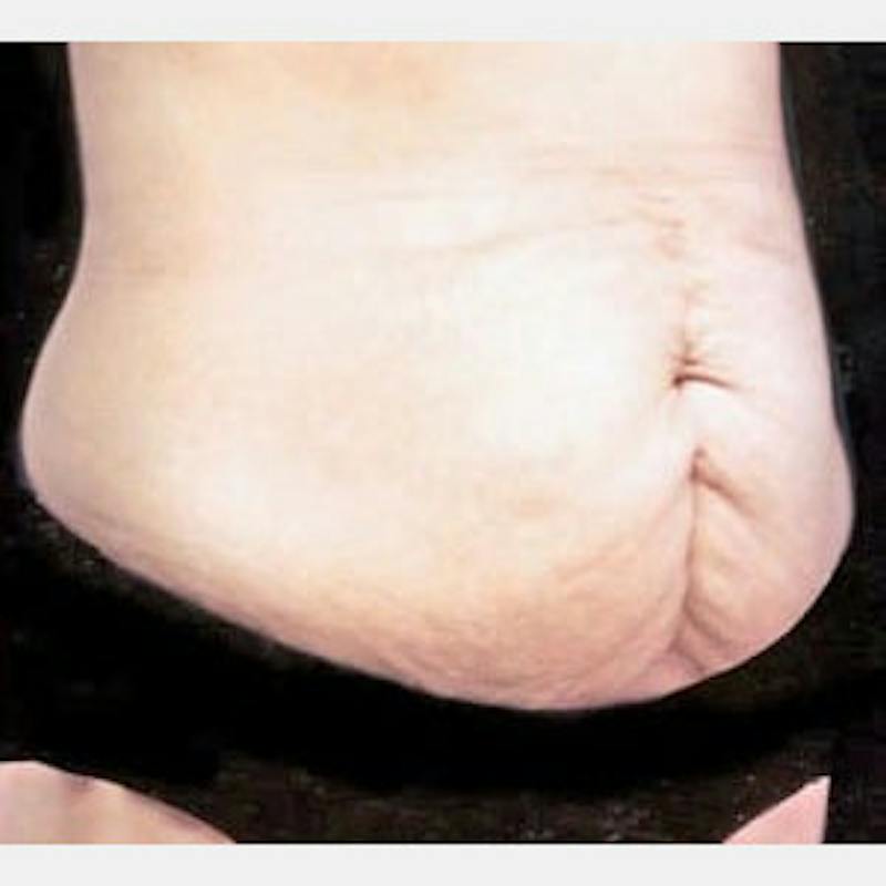 Abdominoplasty (Tummy Tuck) Before & After Gallery - Patient 224503 - Image 3