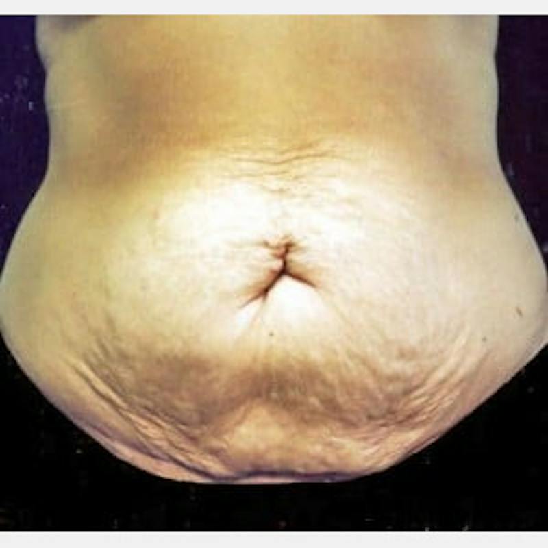 Abdominoplasty (Tummy Tuck) Before & After Gallery - Patient 134269 - Image 1