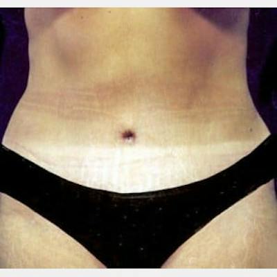 Abdominoplasty (Tummy Tuck) Before & After Gallery - Patient 134269 - Image 2