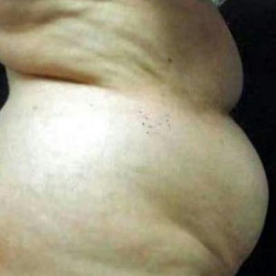Abdominoplasty (Tummy Tuck) Before & After Gallery - Patient 208619 - Image 1