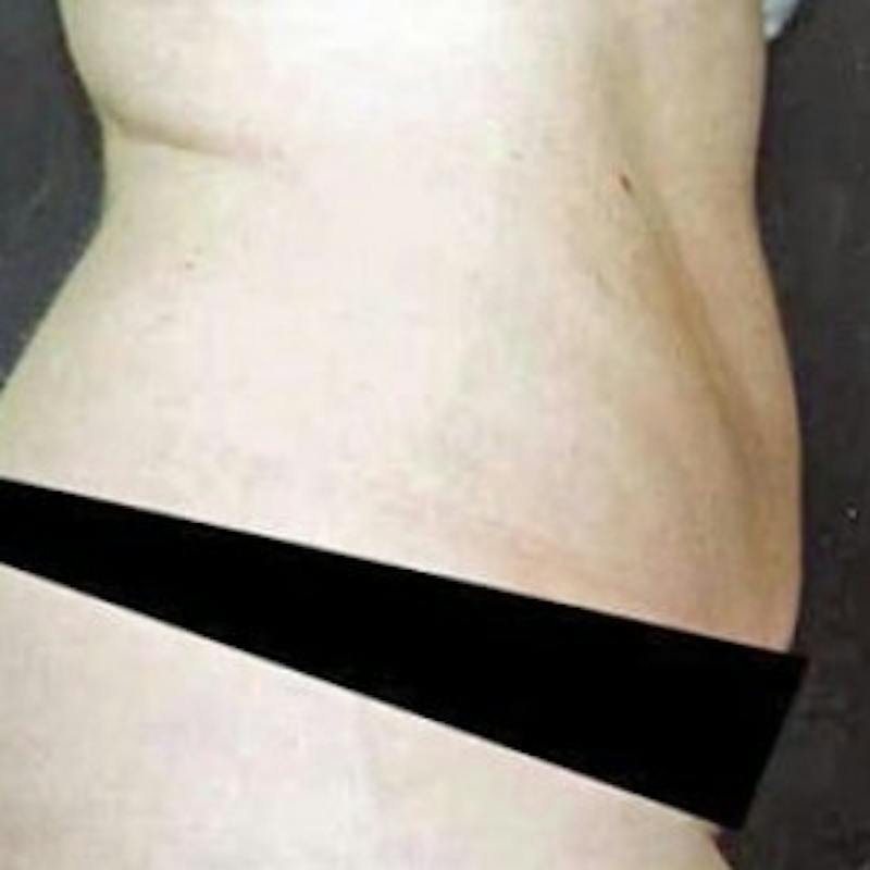 Abdominoplasty (Tummy Tuck) Before & After Gallery - Patient 208619 - Image 2