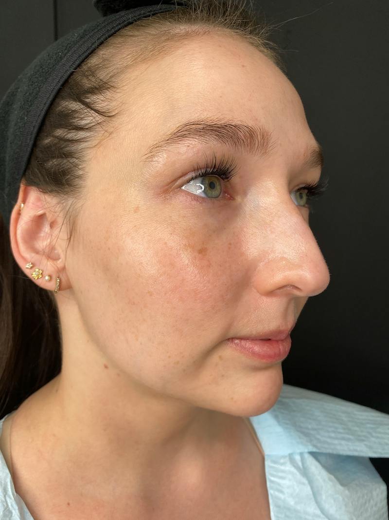 Laser Skin Treatments Before & After Gallery - Patient 374284 - Image 1