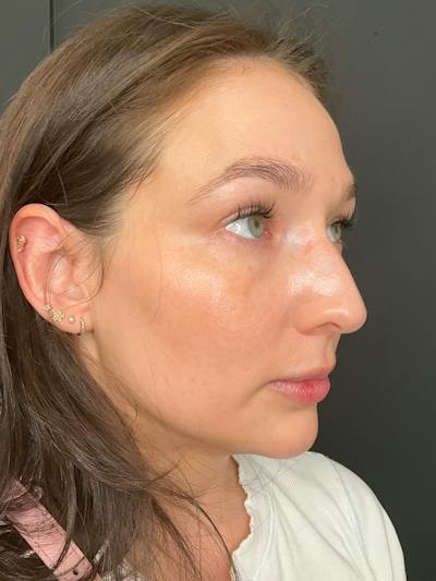 Laser Skin Treatments Before & After Gallery - Patient 374284 - Image 2