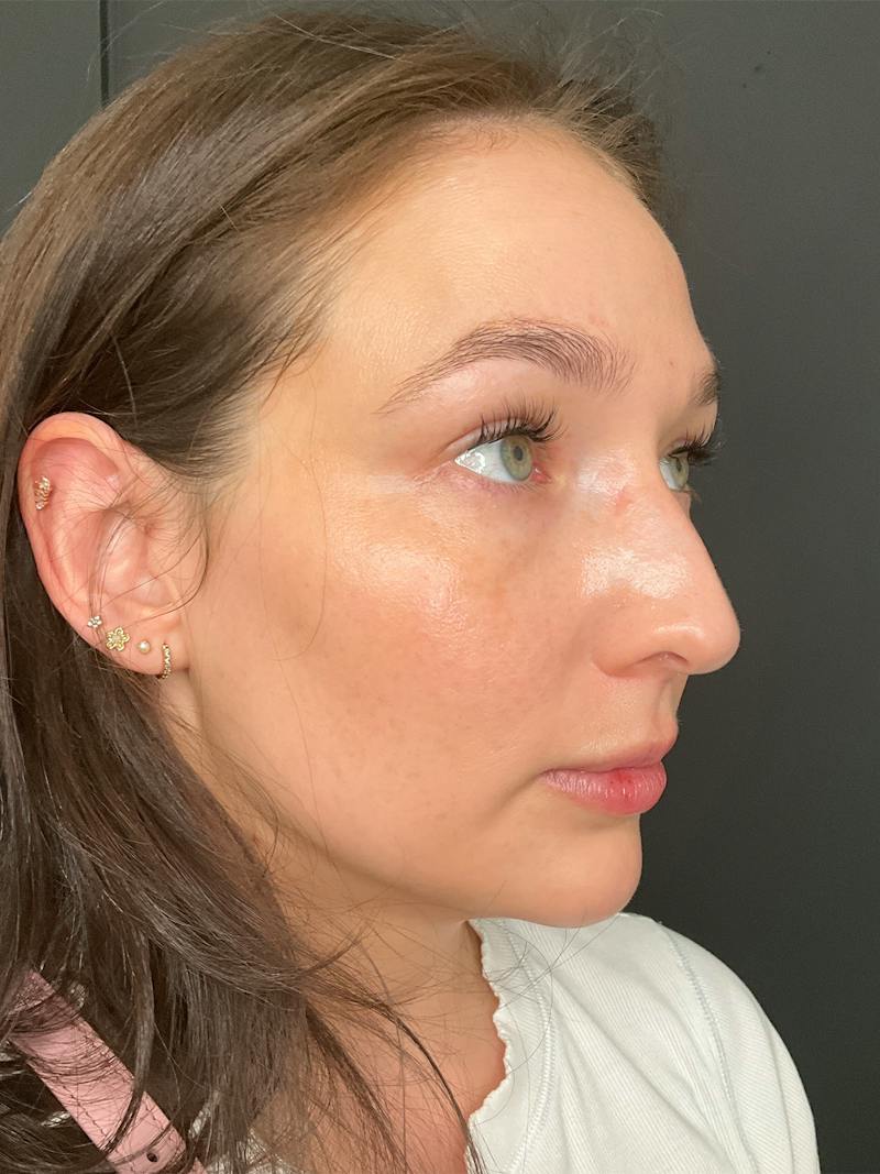 Laser Skin Treatments Before & After Gallery - Patient 374284 - Image 2