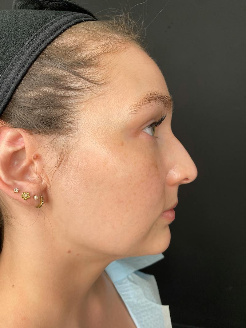 Laser Skin Treatments Before & After Gallery - Patient 374284 - Image 3