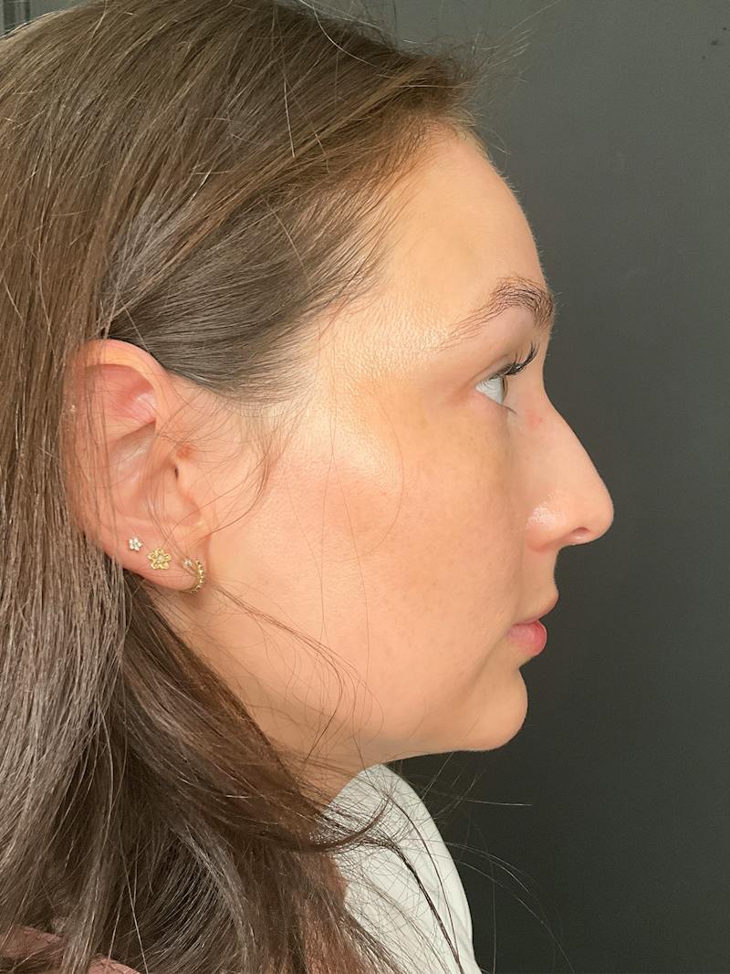 Laser Skin Treatments Before & After Gallery - Patient 374284 - Image 4