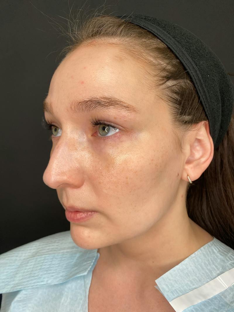 Laser Skin Treatments Before & After Gallery - Patient 374284 - Image 5