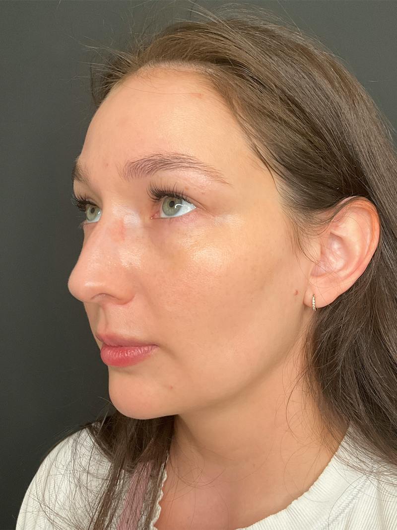 Laser Skin Treatments Before & After Gallery - Patient 374284 - Image 6