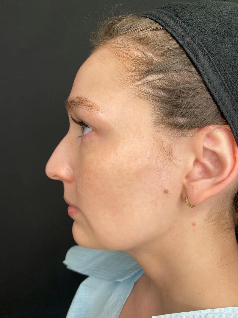Laser Skin Treatments Before & After Gallery - Patient 374284 - Image 7