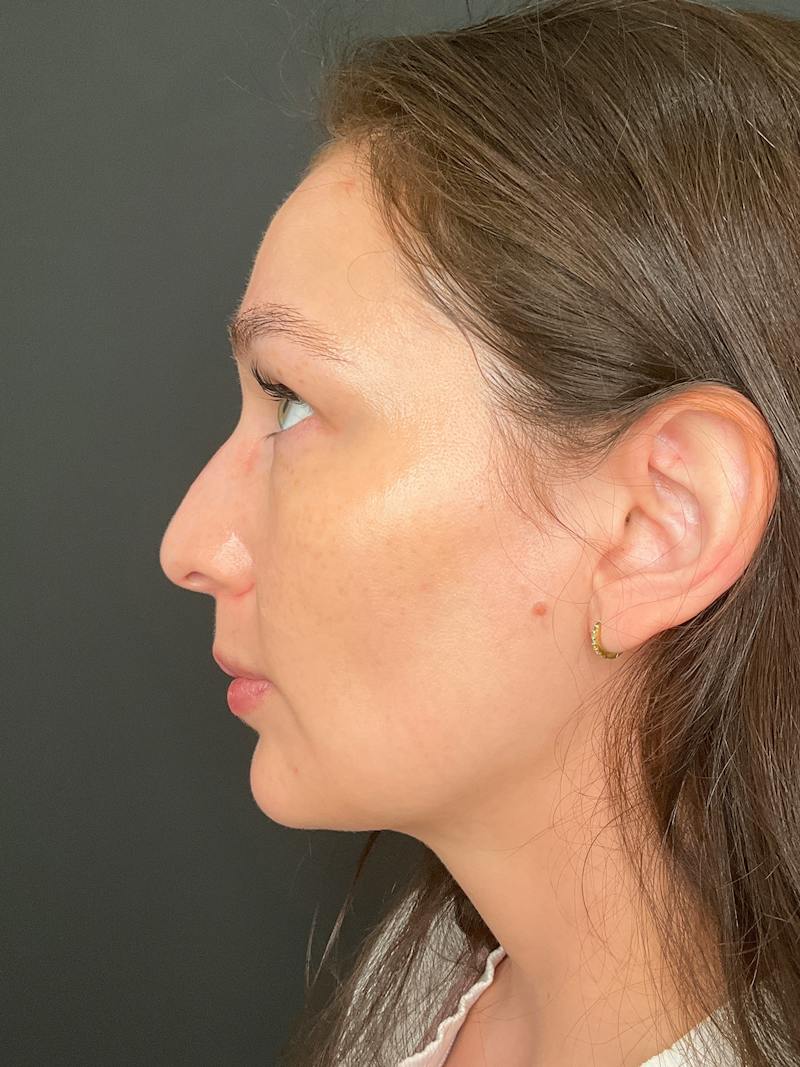Laser Skin Treatments Before & After Gallery - Patient 374284 - Image 8
