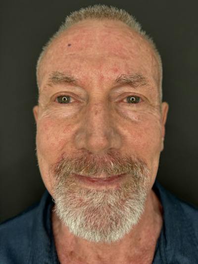 Laser Skin Treatments Before & After Gallery - Patient 370124 - Image 1