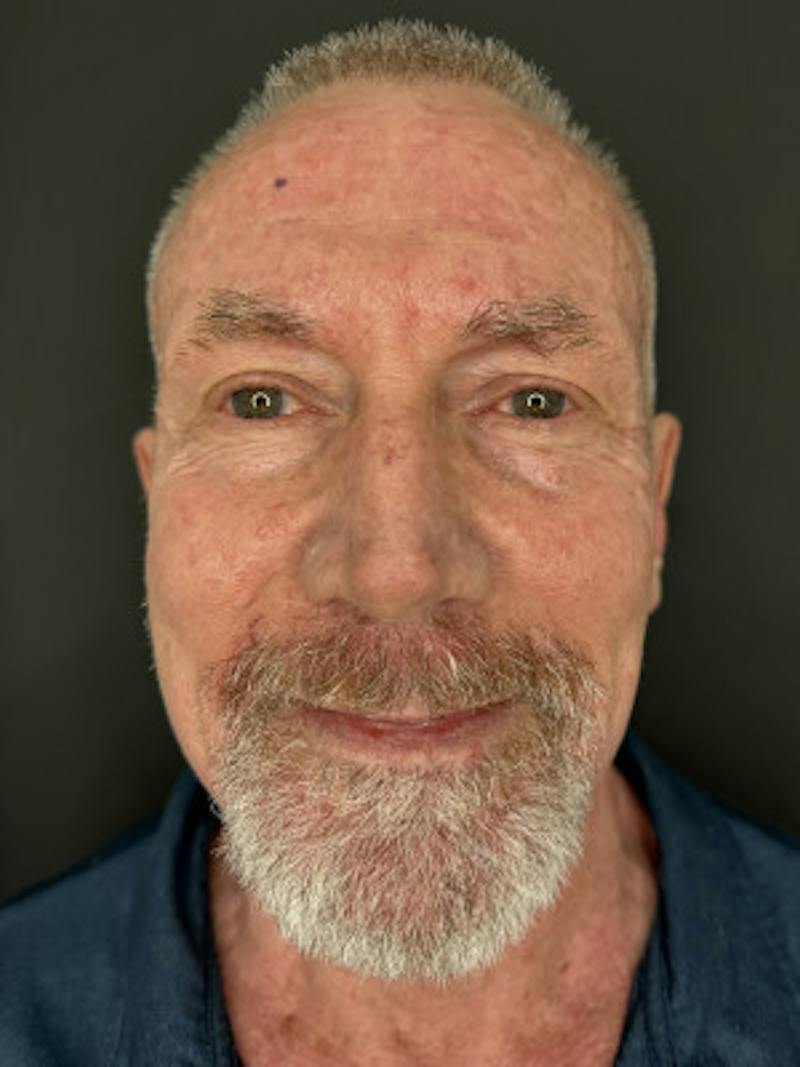 Laser Skin Treatments Before & After Gallery - Patient 370124 - Image 1