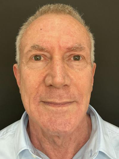 Laser Skin Treatments Before & After Gallery - Patient 370124 - Image 2