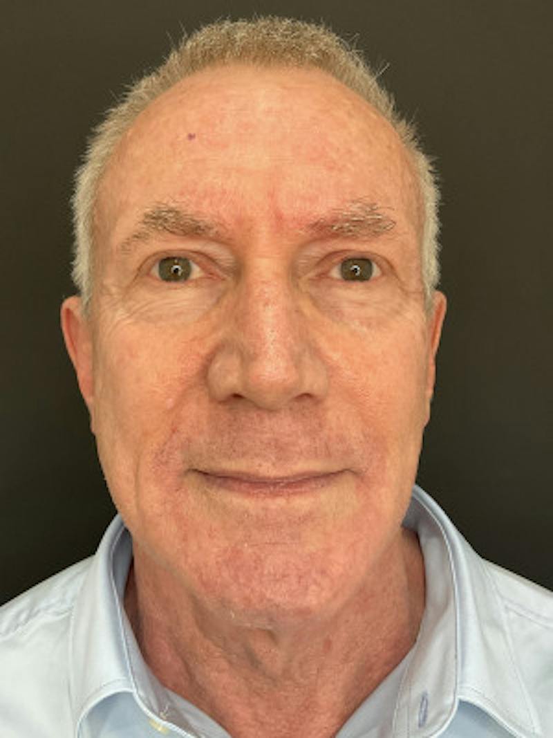 Laser Skin Treatments Before & After Gallery - Patient 370124 - Image 2