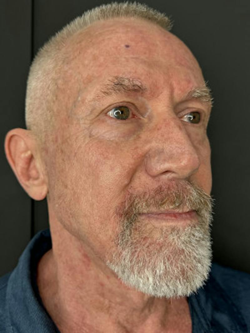 Laser Skin Treatments Before & After Gallery - Patient 370124 - Image 3