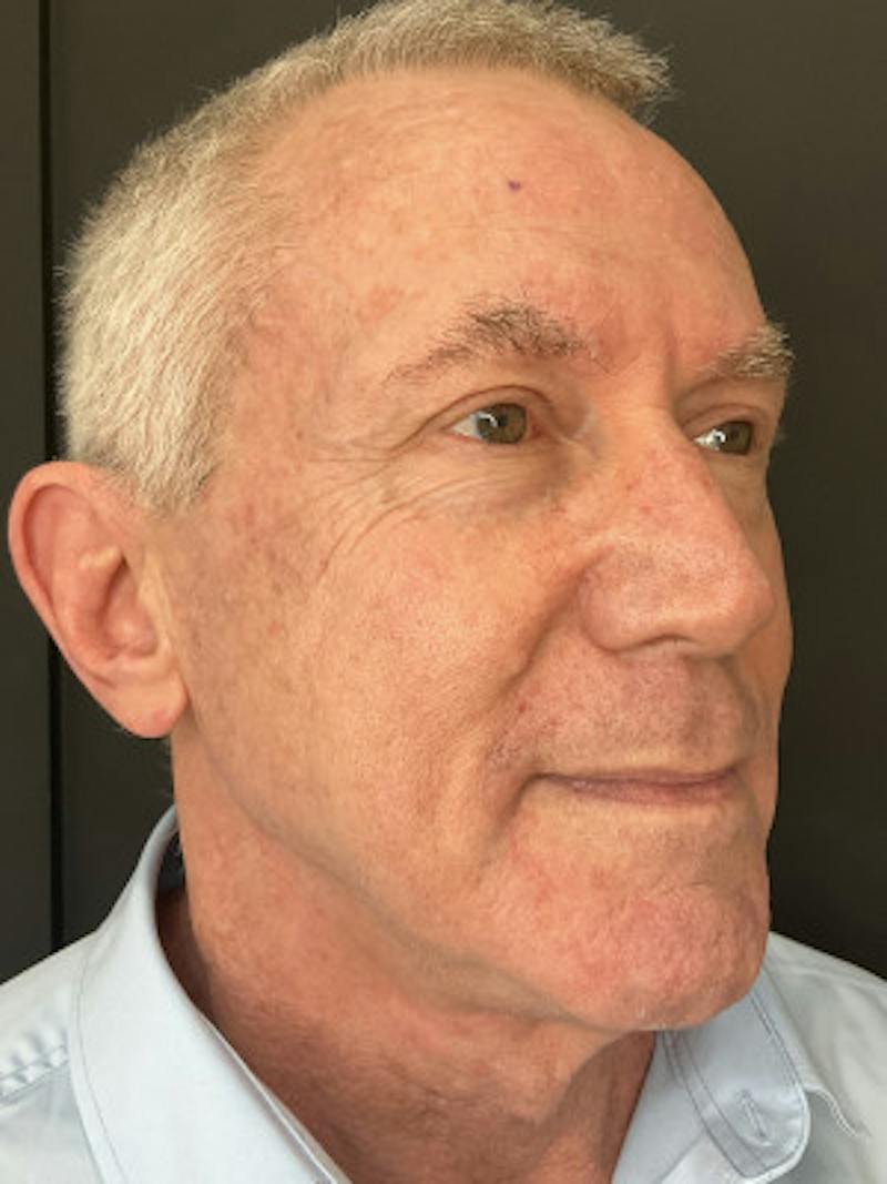 Laser Skin Treatments Before & After Gallery - Patient 370124 - Image 4