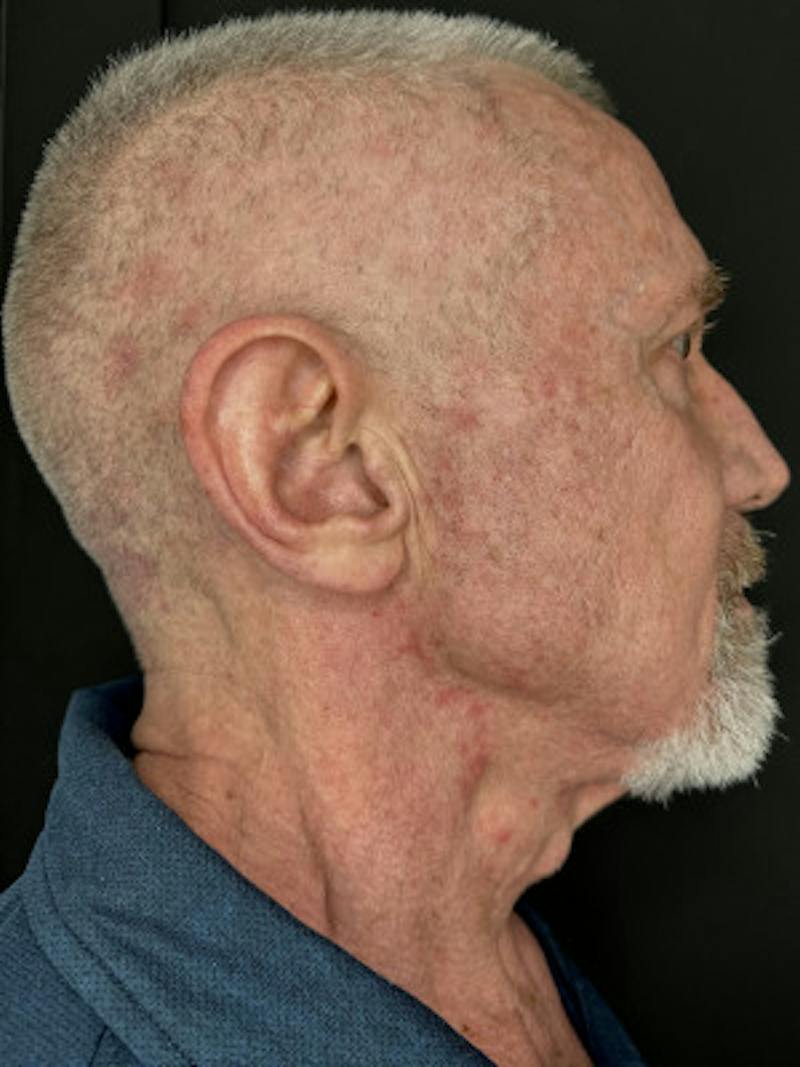 Laser Skin Treatments Before & After Gallery - Patient 370124 - Image 5