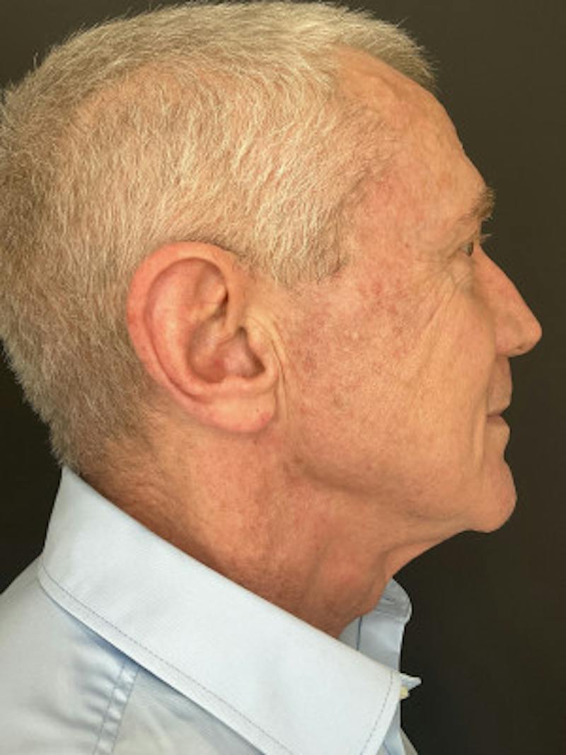 Laser Skin Treatments Before & After Gallery - Patient 370124 - Image 6