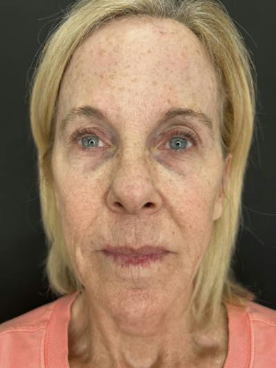 Laser Skin Treatments Before & After Gallery - Patient 400366 - Image 1