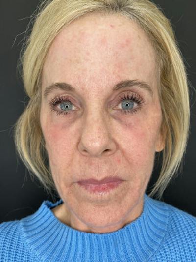 Laser Skin Treatments Before & After Gallery - Patient 400366 - Image 2