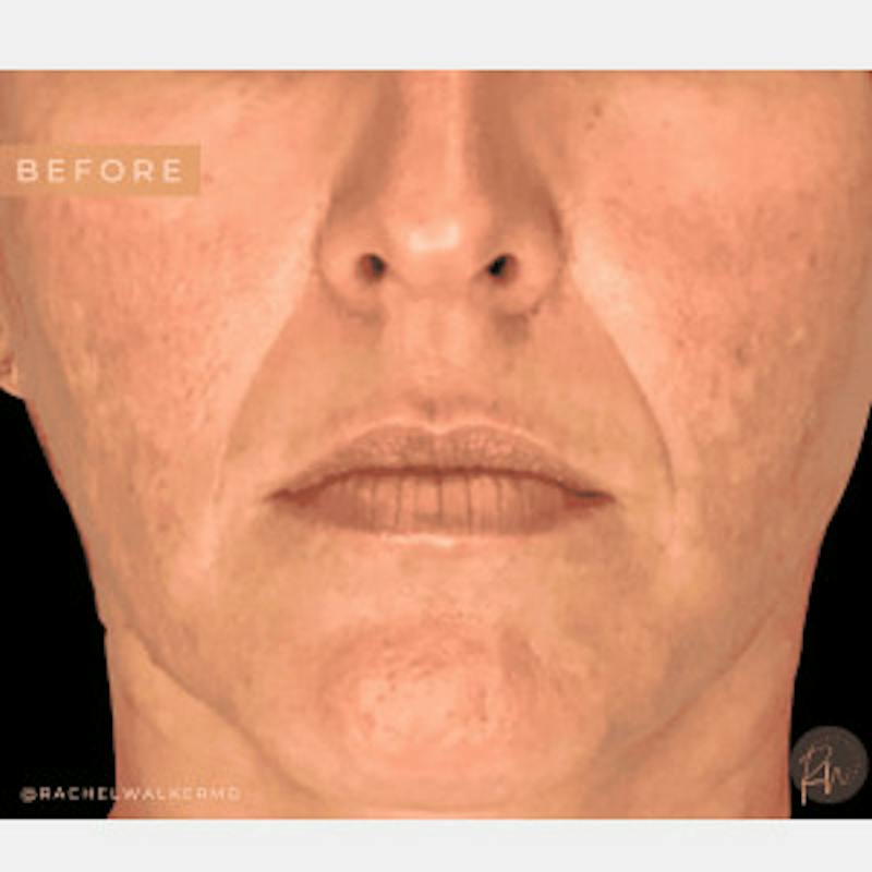 Laser Skin Treatments Before & After Gallery - Patient 426863 - Image 1