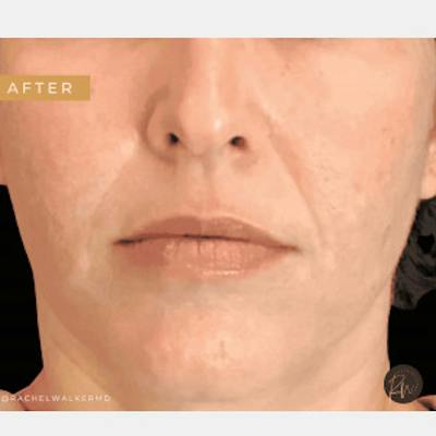 Laser Skin Treatments Before & After Gallery - Patient 426863 - Image 2