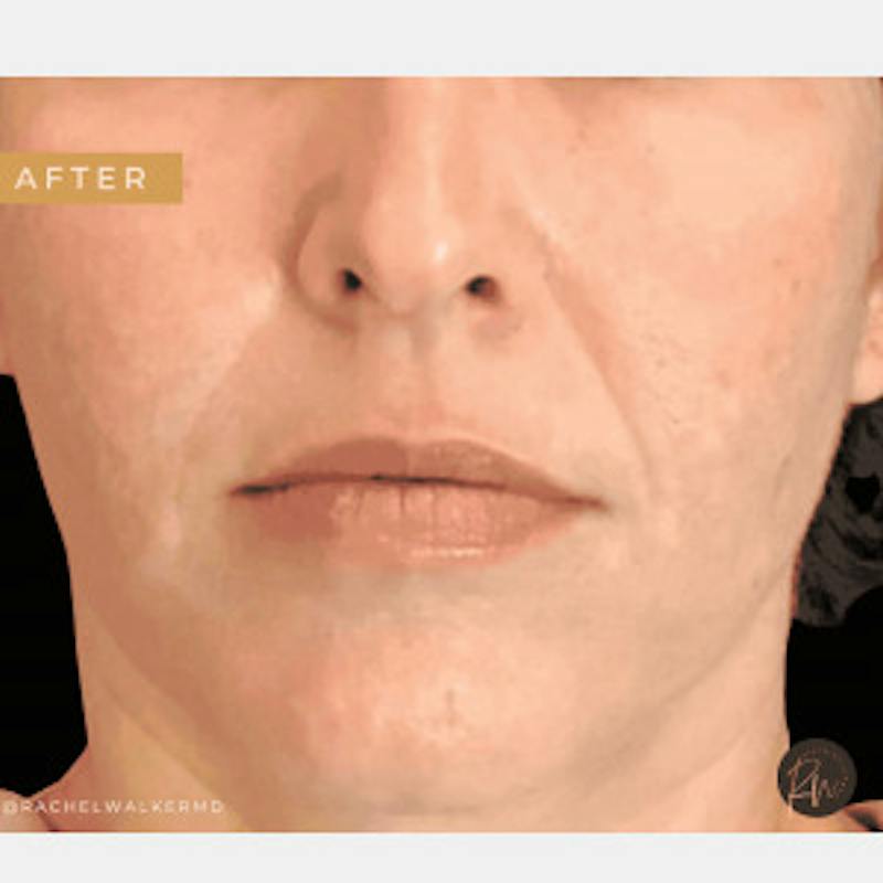 Laser Skin Treatments Before & After Gallery - Patient 426863 - Image 2