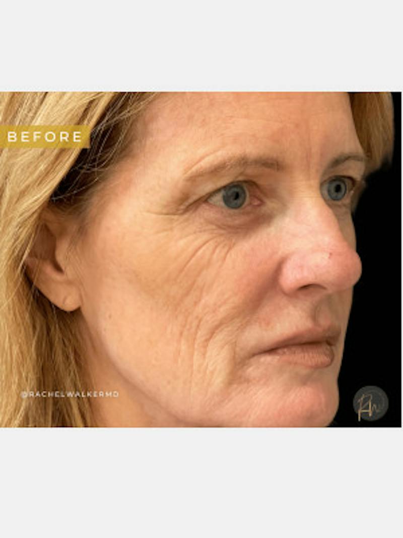 Laser Skin Treatments Before & After Gallery - Patient 194988 - Image 1