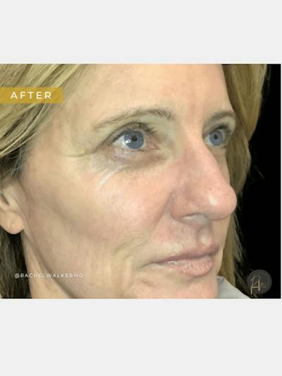 Laser Skin Treatments Before & After Gallery - Patient 194988 - Image 2