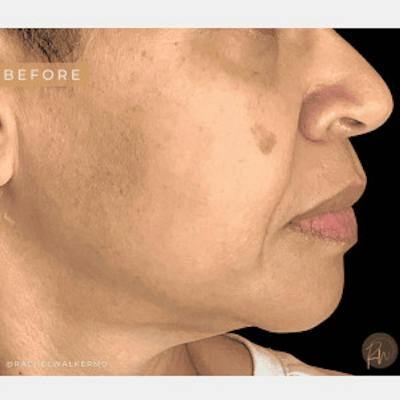 Laser Skin Treatments Before & After Gallery - Patient 208451 - Image 1