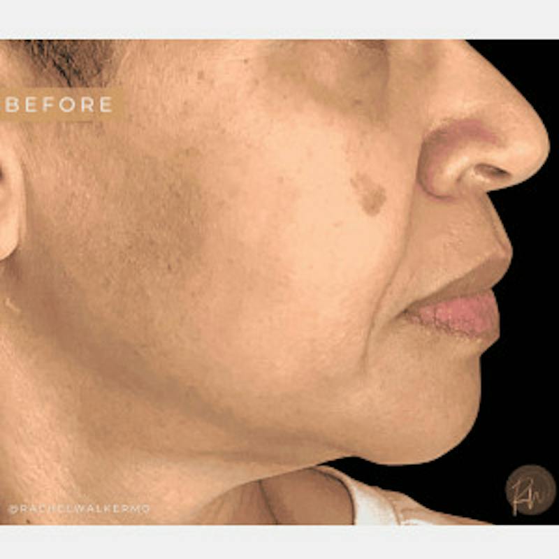 Laser Skin Treatments Before & After Gallery - Patient 208451 - Image 1