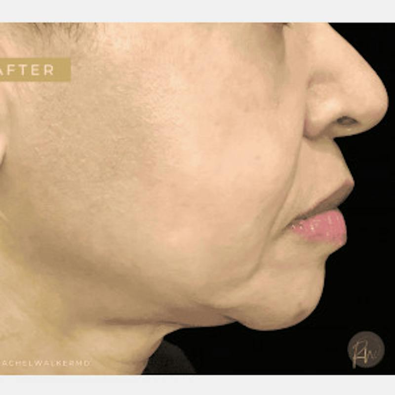 Laser Skin Treatments Before & After Gallery - Patient 208451 - Image 2
