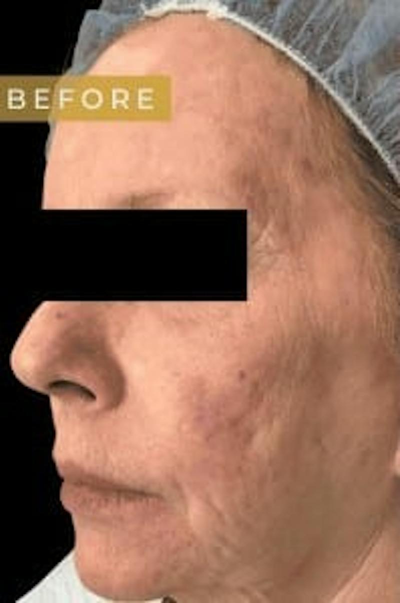 Laser Skin Treatments Before & After Gallery - Patient 698078 - Image 1