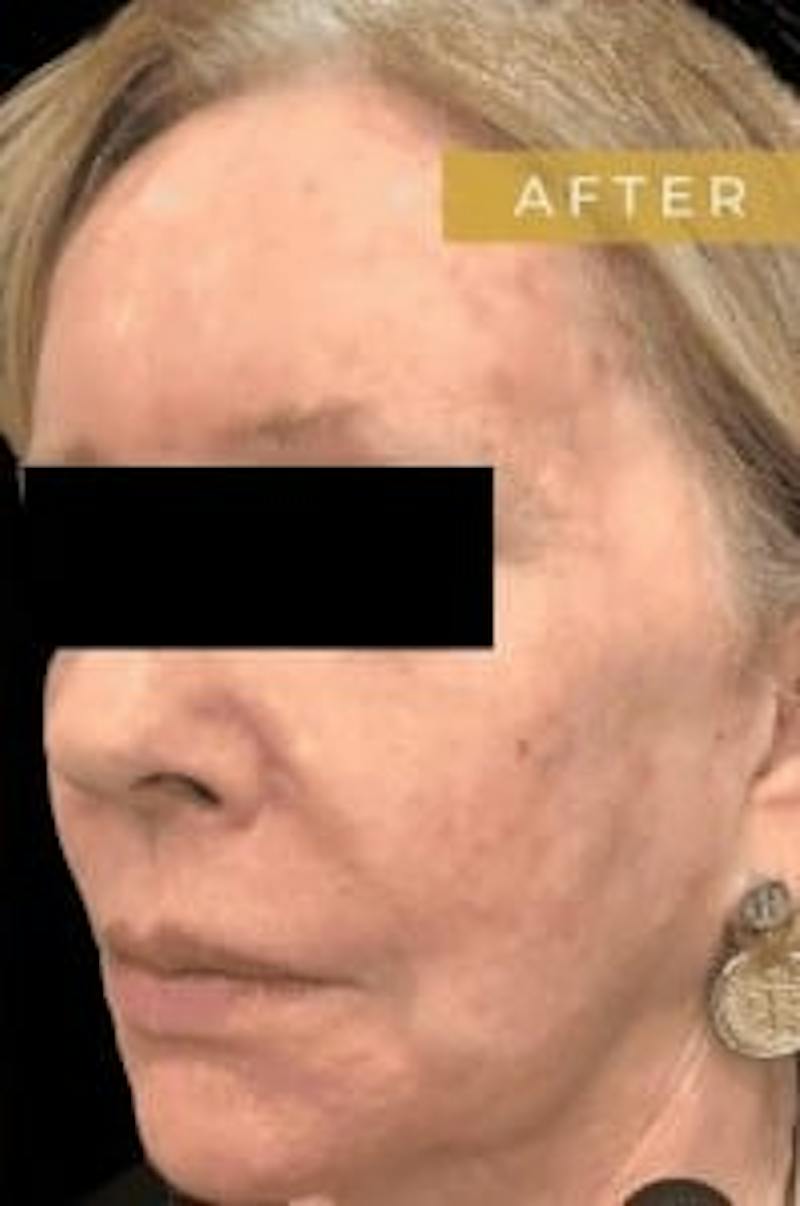 Laser Skin Treatments Before & After Gallery - Patient 698078 - Image 2