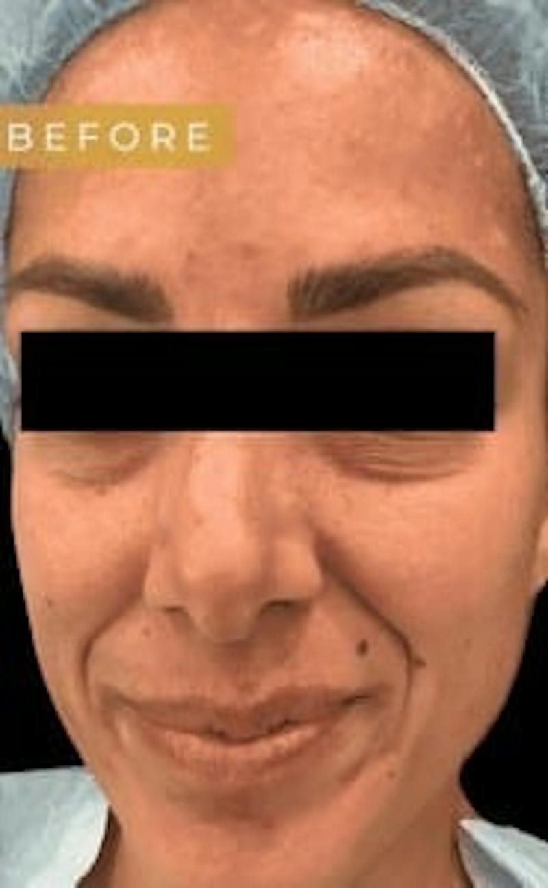 Laser Skin Treatments Before & After Gallery - Patient 699292 - Image 1