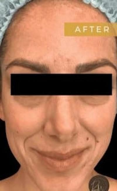 Laser Skin Treatments Before & After Gallery - Patient 699292 - Image 2