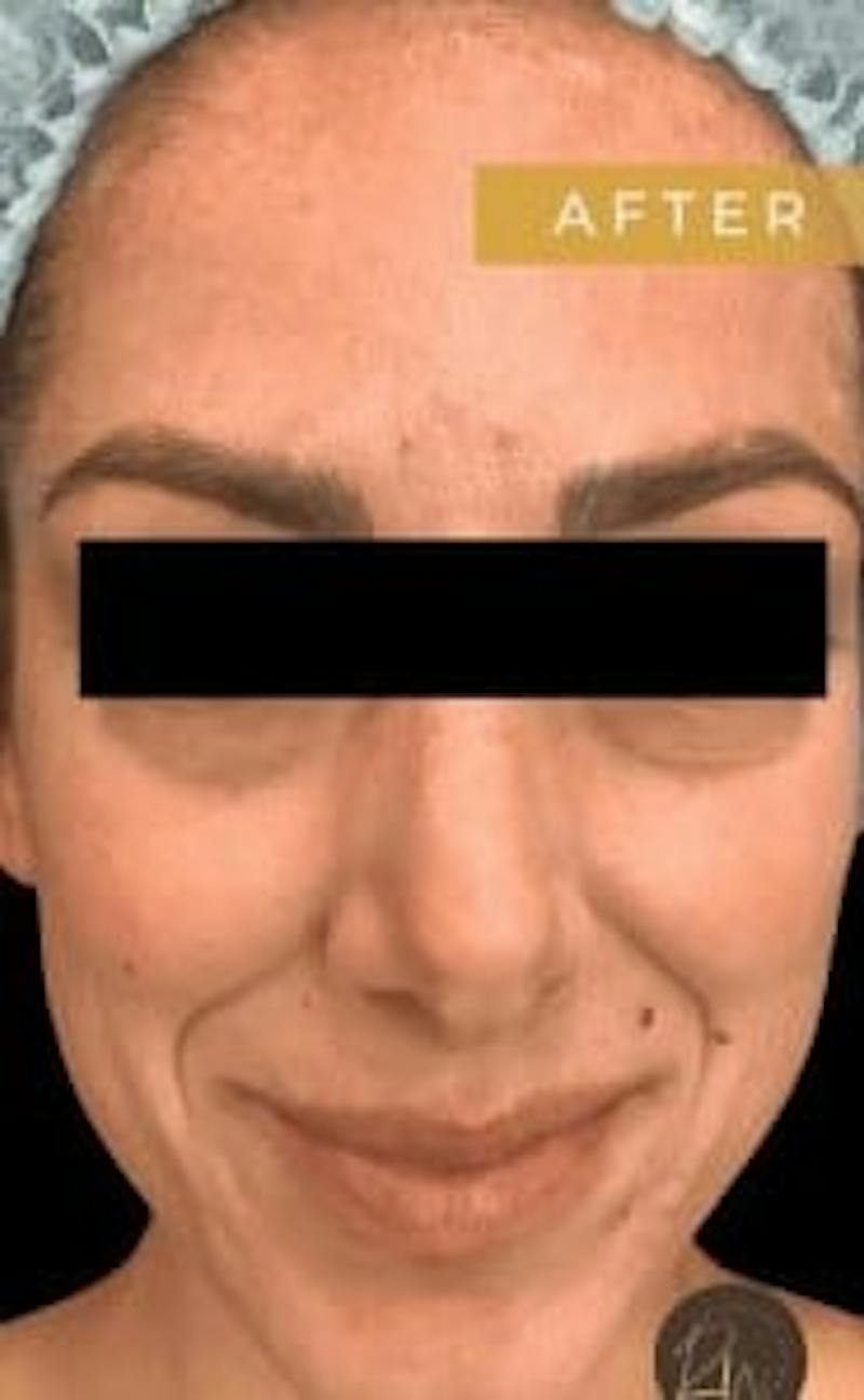 Laser Skin Treatments Before & After Gallery - Patient 699292 - Image 2