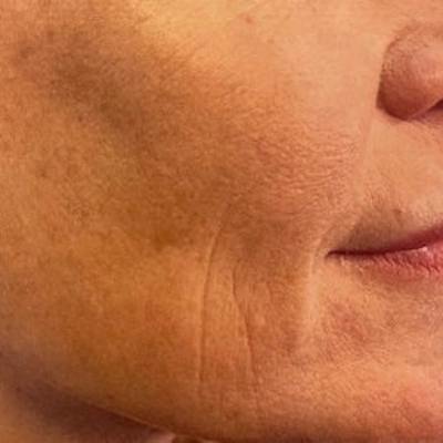 Laser Skin Treatments Before & After Gallery - Patient 109968 - Image 1
