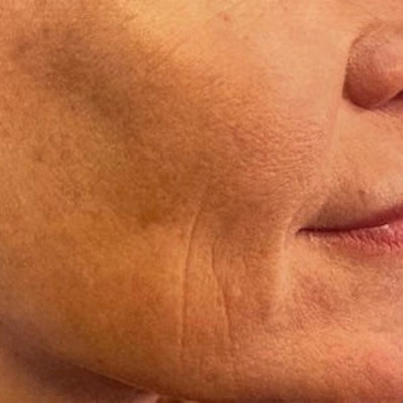Laser Skin Treatments Before & After Gallery - Patient 109968 - Image 1