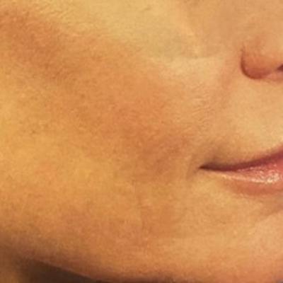 Laser Skin Treatments Before & After Gallery - Patient 109968 - Image 2