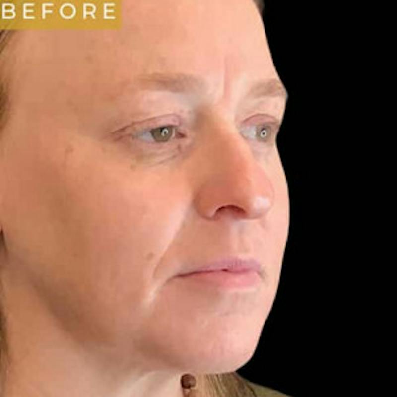 Laser Skin Treatments Before & After Gallery - Patient 398684 - Image 1