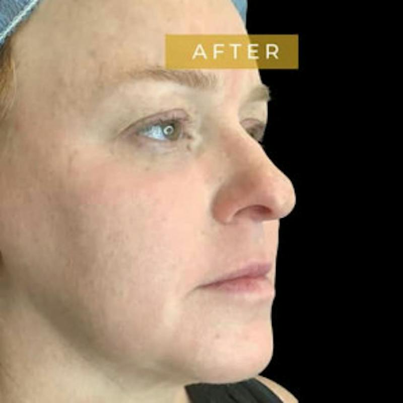 Laser Skin Treatments Before & After Gallery - Patient 398684 - Image 2