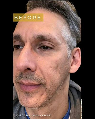 Laser Skin Treatments Before & After Gallery - Patient 611184 - Image 1
