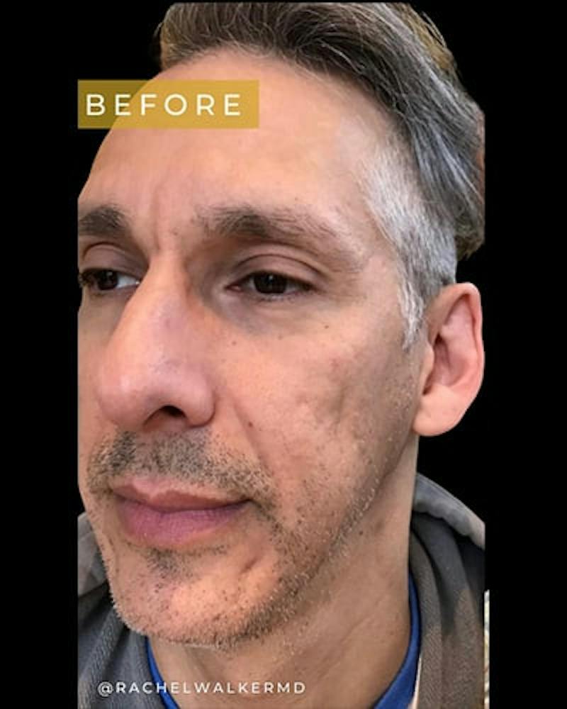 Laser Skin Treatments Before & After Gallery - Patient 611184 - Image 1