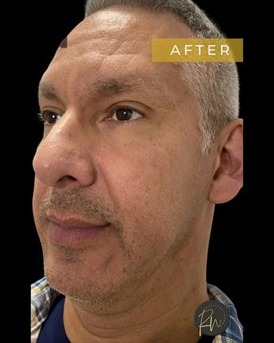 Laser Skin Treatments Before & After Gallery - Patient 611184 - Image 2