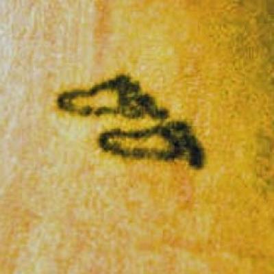 Laser Skin Treatments Before & After Gallery - Patient 195935 - Image 1